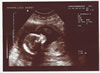 10th scan picture