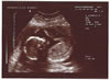 11th scan picture