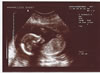 13th scan picture