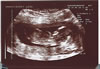 2nd scan picture