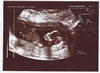 3rd scan picture