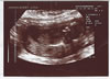 4th scan picture