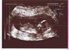 5th scan picture