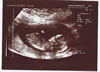 6th scan picture