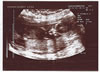 9th scan picture